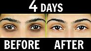 How to Remove Dark Circles Naturally in 4 Days (100% Results) | Anaysa