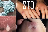 STD Sexually Transmitted Infections Treatment