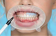 All you need to know about teeth whitening in Turkey: its types and caveats