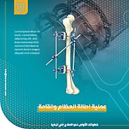 The process of lengthening the bones and height in Turkey - Bimaristan