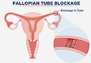 Fallopian Tube Blockage Treatment in Lahore | Dr. Goufen Liu