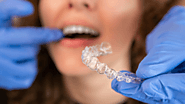 A Step-by-Step Guide to Invisalign