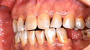 Can Teeth Bonding Fix Discolored Teeth? Here's What You Need to Know