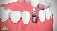 Best Dental Implants Clinic Cosmodent India