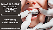Invisible Braces Offer A Number Of Benefits. What Are They?