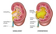 Kidney obstruction-Kidney specialist