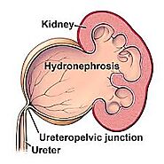 Obstruction of Kidney (گردے کی رکاوٹ) - Clinic Of Urology & Kidney Transplant