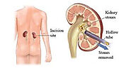 Treatment Of Kidney Stones ( گردےکی پتھری کاعلاج) - Clinic Of Urology & Kidney Transplant