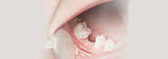 Hypodontia: Causes and Treatment for Congenitally Missing Teeth