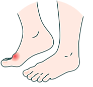 Gout: Causes, Symptoms and Treatment Medications