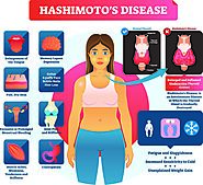 Treatment for Hashimoto's Disease - Philadelphia Holistic Clinic - Dr. Tsan