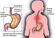 Treatment for GERD - Philadelphia Homeopathic Clinic - Dr. Tsan & Assoc.