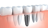 Restorative Dentistry Beaumont, AB | Dental Restorations Near You