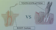 Root canal Vs. tooth extraction -what should you choose?