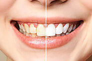 Website at https://moderndentalroswell.com/why-should-you-use-professional-teeth-whitening-services/
