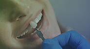 Dental Veneers -What are They and How do They Work?
