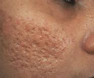 Pimple Treatment | Acne Treatment | Acne Scar Treatment | Pimple Scar Treatment | Pimple.sg