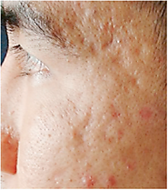 Deep Pimple Scars #AcneTreatment | #AcneScarTreatment | #PimpleScarTreatment