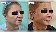 FACELIFT SURGERY FOR A YOUTHFUL LOOK