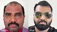 Best hair Transplant in Jaipur | Dr Akangsha Sharma