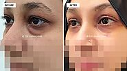 Why Blepharoplasty Is A Popularly Performed Cosmetic Surgery? - Blogs Binder