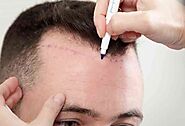 Why Do People Opt For Hair Transplantation? - Blogs Binder