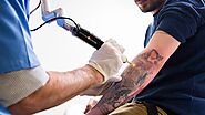 Tattoo Removal Laser Surgery