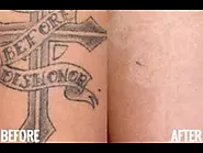 Get Rid of That Tattoo With Tattoo Laser Removal