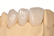 IPS E-Max | High Strength Translucent Porcelain Veneer | DentCare Dental Lab