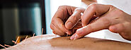 Drive Away Illness And Disorders Of Your Body With Acupuncture.