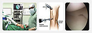 What Is Arthroscopy Surgery, Procedure, Advantages & Recovery