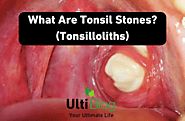 What Are Tonsil Stones? (Tonsilloliths)