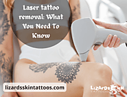 Laser tattoo removal: What You Need To Know