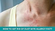 How to Get Rid of Dust Mite Allergy Fast?