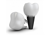 5 Amazing Benefits Of Dental Implants