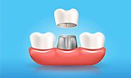 5 Instances When You Should Get Dental Crowns