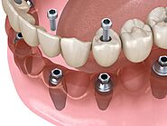 Center for Dental Implants | Dental Implants in Fort Collins, CO