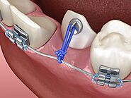 Treatments for Partial Impacted Canine Teeth