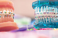 Orthodontics | Orleans orthodontics - Orleans Dental Arts