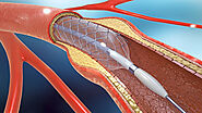 Coronary Balloon Angioplasty and Stenting in Colorado Denver