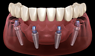 5 Reasons To Choose All-On-4-Implants