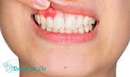 Know The Common Signs Of Periodontitis