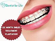 Six Month Smiles Treatment in Plantation