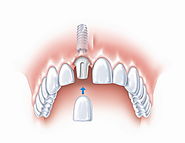 Tips for Wisdom Teeth Removal