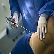 Liposuction in Faridabad - Dr Kiranmayi Atla | Beauty & The Cut
