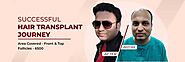 Top Hair Transplant In Delhi , Gurgaon (India) | Cost | Doctor & Surgery