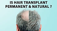 Is Hair Transplant Permanent and Natural? - What to Expect Long-Term