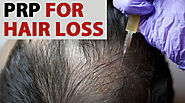 Hair PRP for Hair Loss - Can It Reverse Baldness Without Surgery Treatment
