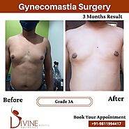 Gynecomastia Surgery In Noida & Male Breast Reduction Procedure Cost