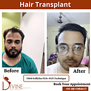 Semi Robotic Hair Transplant Surgery Cost In Delhi , Gurgaon & India